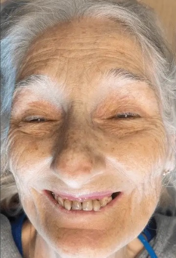 Patient 4 before