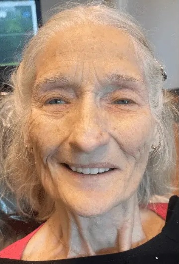 Patient 4 after